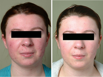 Before Treatment / After Treatment